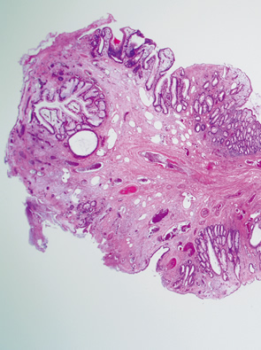 Colonic muco-submucosal elongated polyp