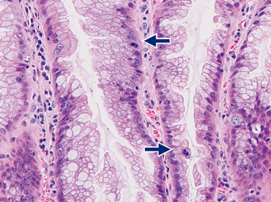 sessile serrated adenoma/polyp e