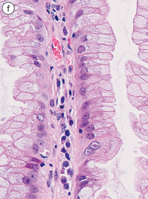 sessile serrated adenoma/polyp f