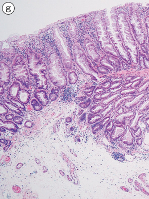 sessile serrated adenoma/polyp g