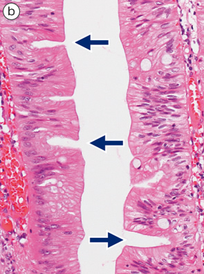 鋸歯状腺腫（traditional type）とmixed polyp b