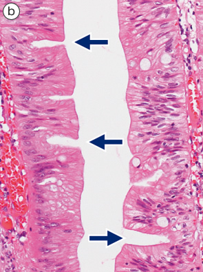 鋸歯状腺腫（traditional type）とmixed polyp b
