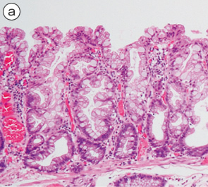 sessile serrated adenoma/polyp a