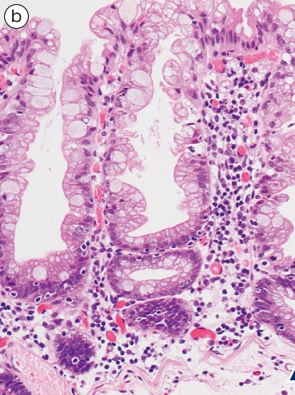 sessile serrated adenoma/polyp b