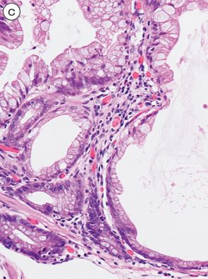 sessile serrated adenoma/polyp c