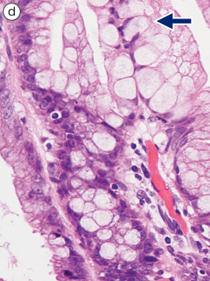 sessile serrated adenoma/polyp d