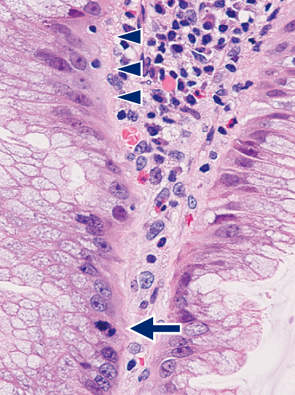 sessile serrated adenoma/polyp f