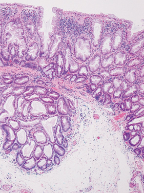 sessile serrated adenoma/polyp g