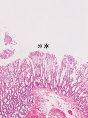 鋸歯状腺腫（traditional type）とmixed polyp a