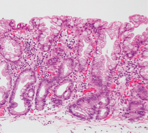 sessile serrated adenoma/polyp a