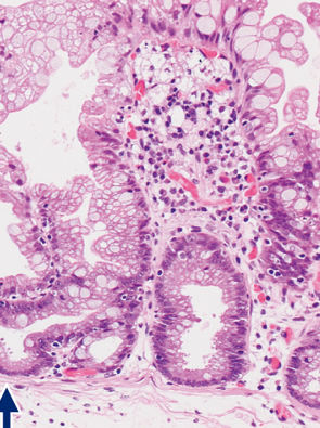 sessile serrated adenoma/polyp b