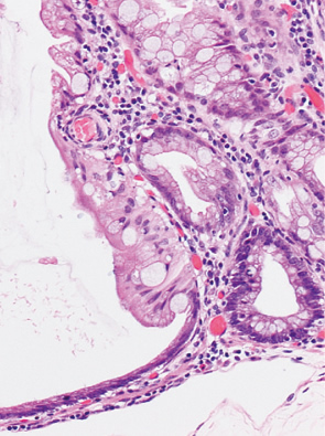 sessile serrated adenoma/polyp c