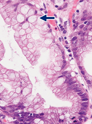 sessile serrated adenoma/polyp d