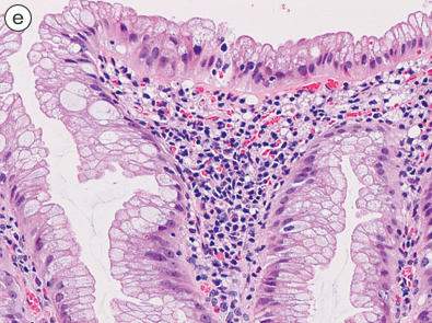 sessile serrated adenoma/polyp e