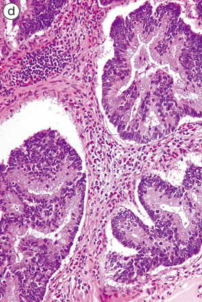 腺腫成分を伴う粘液嚢胞腺癌d
