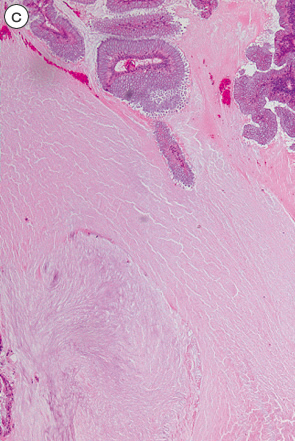 腹膜偽粘液腫を伴う粘液嚢胞腺腫c