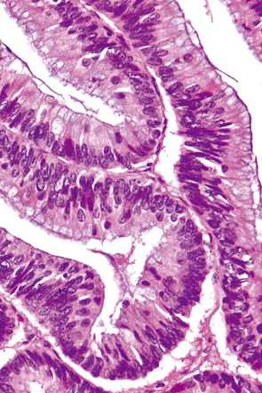 腺腫成分を伴う粘液嚢胞腺癌c
