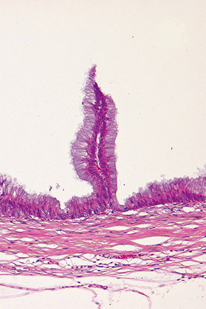 低異型度の粘液嚢胞腺腫c