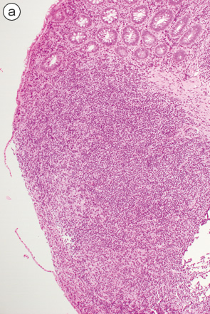 大腸マントル細胞リンパ腫a