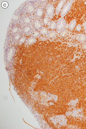大腸マントル細胞リンパ腫c