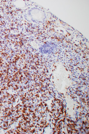 濾胞辺縁帯の過形成性病変との鑑別が困難であった直腸MALTリンパ腫b