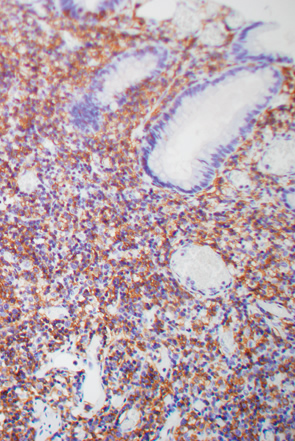 濾胞辺縁帯の過形成性病変との鑑別が困難であった直腸MALTリンパ腫d