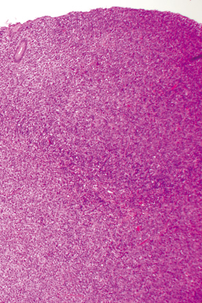 大腸びまん性大型B細胞性リンパ腫a