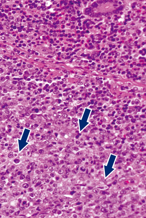大腸びまん性大型B細胞性リンパ腫b