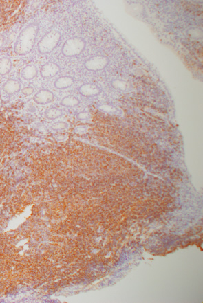 大腸マントル細胞リンパ腫b