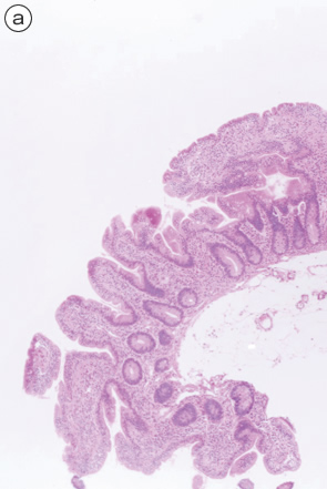 tropical sprue, celiac disease