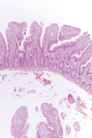 tropical sprue, celiac disease