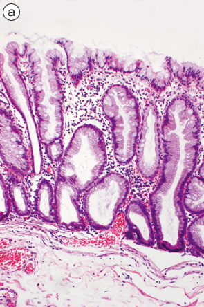 SSA/P＋dysplastic SSA/P a