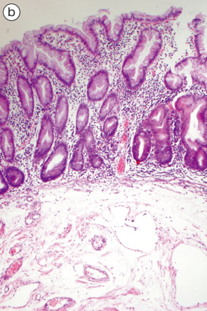 SSA/P＋dysplastic SSA/P b