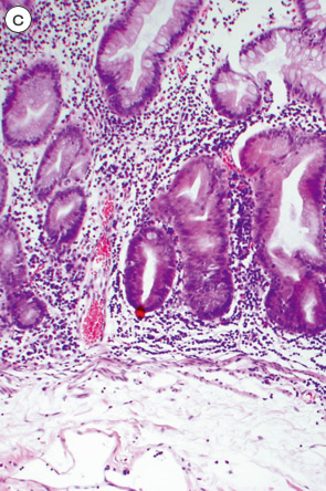 SSA/P＋dysplastic SSA/P c