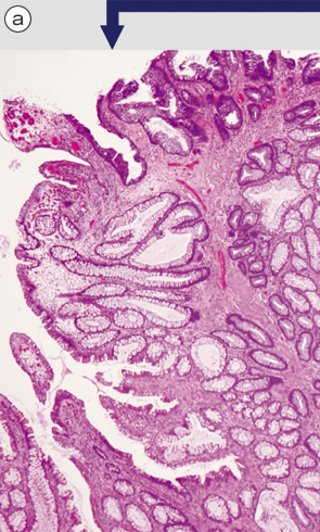 Mucosal prolapse syndrome（MPS）,（polypectomy）a