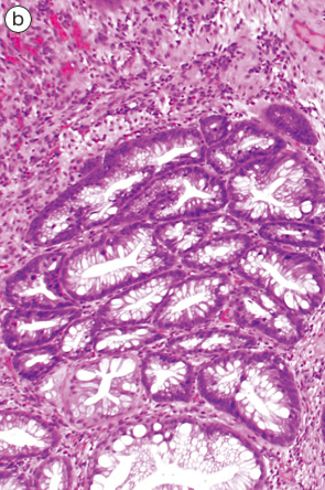 Mucosal prolapse syndrome（MPS）,（polypectomy）b