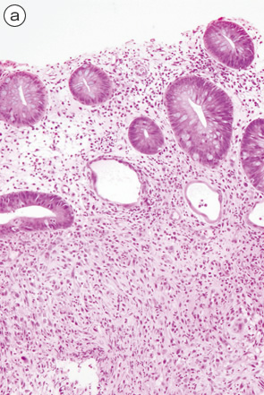 Ulcerative colitis（UC）, indefinite for neoplasia（biopsy）-1 a