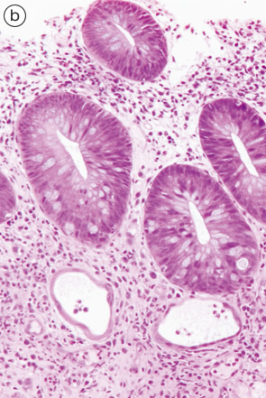 Ulcerative colitis（UC）, indefinite for neoplasia（biopsy）-1 b