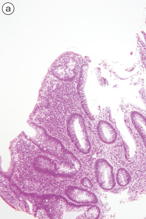 Ulcerative colitis（UC）, indefinite for neoplasia（biopsy）-2 a