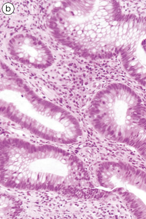 Ulcerative colitis（UC）, indefinite for neoplasia（biopsy）-2 b