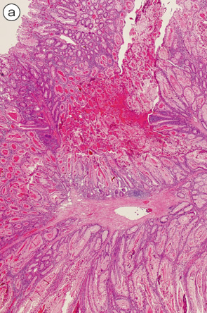 Peutz-Jeghers型ポリープ（polypectomy）a