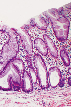 SSA/P＋dysplastic SSA/P a