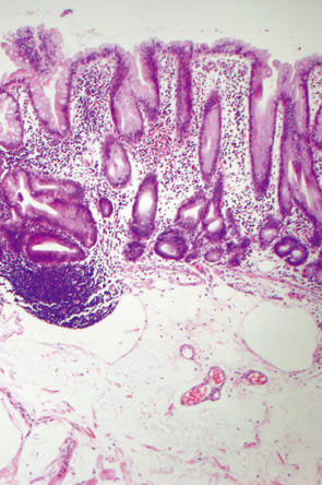 SSA/P＋dysplastic SSA/P b