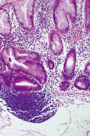 SSA/P＋dysplastic SSA/P c