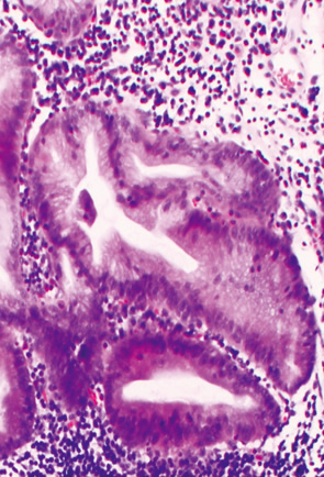 SSA/P＋dysplastic SSA/P d