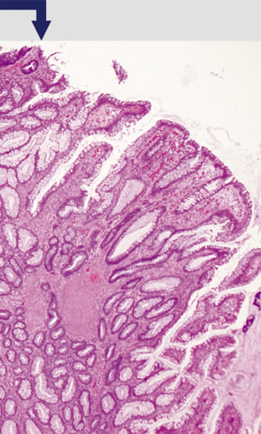 Mucosal prolapse syndrome（MPS）,（polypectomy）a