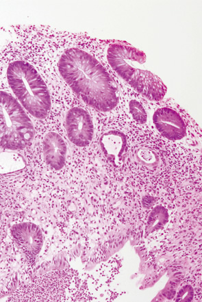 Ulcerative colitis（UC）, indefinite for neoplasia（biopsy）-1 a