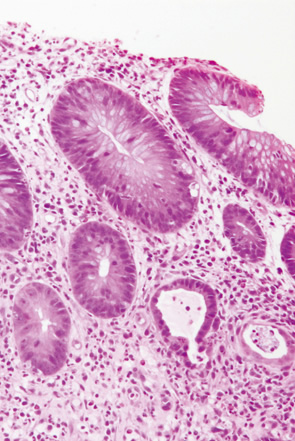 Ulcerative colitis（UC）, indefinite for neoplasia（biopsy）-1 b