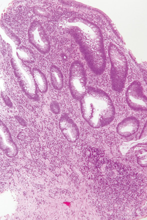 Ulcerative colitis（UC）, indefinite for neoplasia（biopsy）-2 a