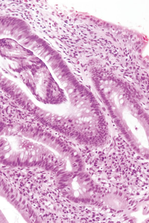 Ulcerative colitis（UC）, indefinite for neoplasia（biopsy）-2 b